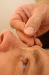 akupunktur mot pollenallergi